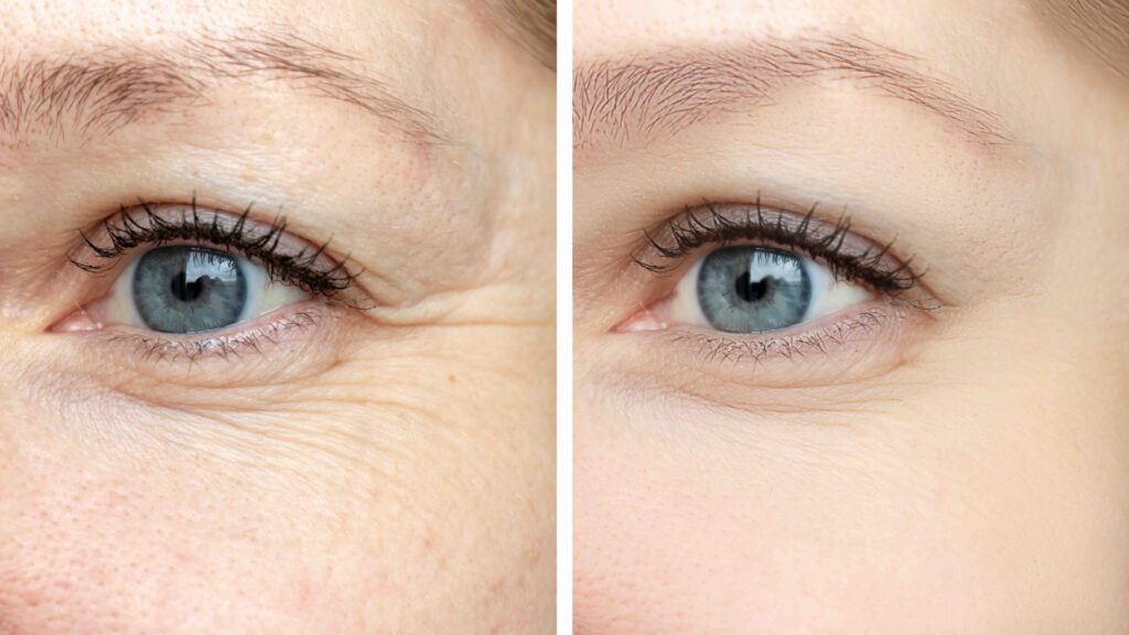 Woman face, eye wrinkles before and after treatment - the result of rejuvenating cosmetological procedures of biorevitalization, botox and pigment spots removal.